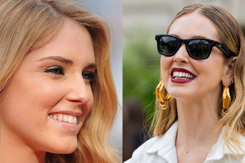 chiara-ferragni-smile-golden-dental