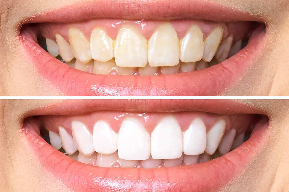 Sbiancamento dentale goldent dental clinic
