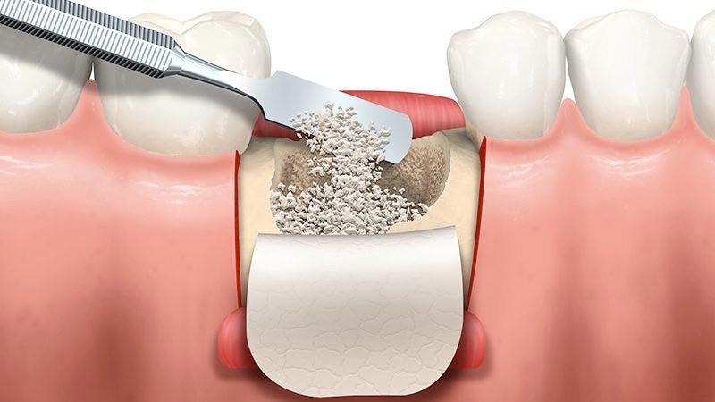 Rigenerazione ossea dentale - Golden Dental