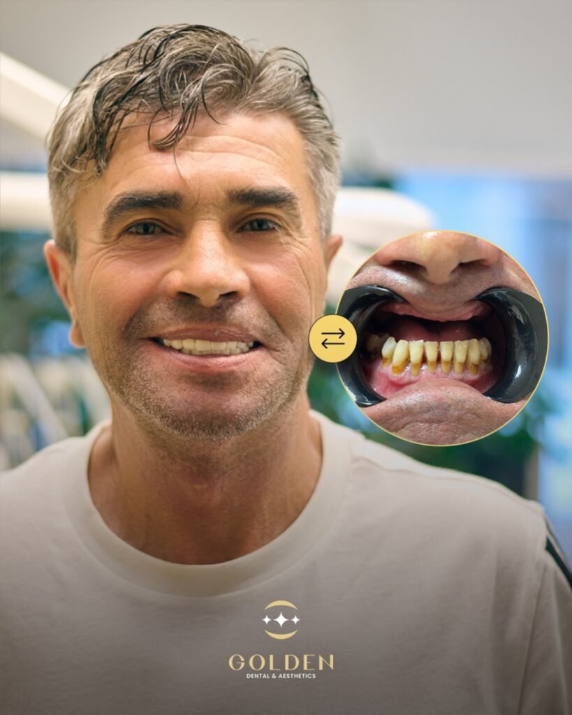 Parodontite, perdita ossea e impianti dentali: è possibile trovare una soluzione? Golden Dental Albania